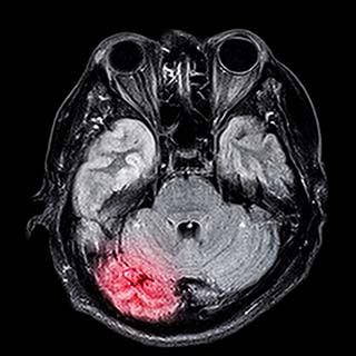 Brain Injuries